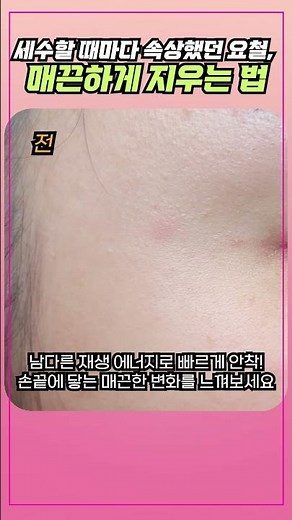 Myeongdong Clinic | 세수할 때마다 속상한 얼굴 요철, 매끈하게 지우는 법! 명동 한의원 편평사마귀 수기 제거 ✨