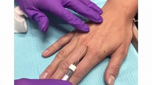 Hand Rejuvination Treatment