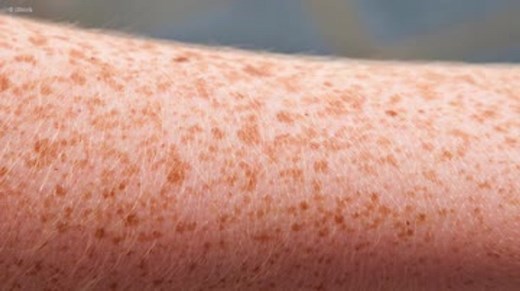 Wie entstehen eigentlich Sommersprossen