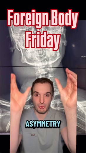 Justin Shafa, M.D. on Instagram: "Sad case for this weeks #foreignbody Friday post - retained IV needles in the neck with a large neck abscess. #radiology #xray #medicine #doctor"