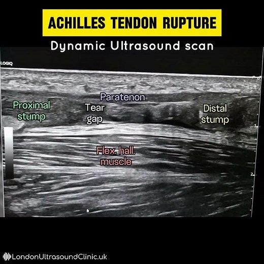 Achilles Tendon Tear