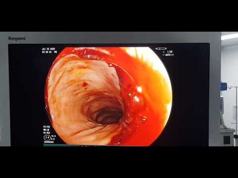 post LAR SURGERY , STAPLE LINE BLEED