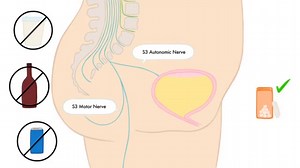 Overactive Bladder - Urogynaecology