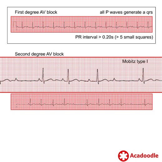 1.6K views | How to Recognize AV Block - Some Quick Tips - Find out more at https://acadoodle.com #emergencymedicine #intensivecare #respiratory #respiratorycare #icu #nurses #icunurse #ecg #ekg #cme #cmeonline | Acadoodle | Facebook