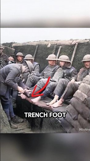 Trench Foot of WWI