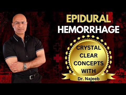 Epidural Hemorrhage | Anatomical | Features & Pathophysiology | Dr Najeeb