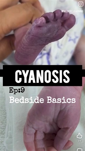 Sudharshini K on Instagram: "Blue, Blue everywhere. . . . Follow @shinikaa_ for more medschool content! VC: 1)@medico_learning 2)YT/@dr.tageldinaly • #life #medstudent #clinicalsmadeeasy #bedsidebasics #bb#wins #new #insta #medschool #mbbs #ug #clinics #final year #studyreel #reels #education#cyanosis #blue"