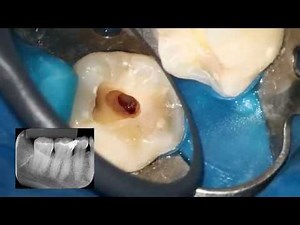 The Wand STA Single Tooth Anesthesia
