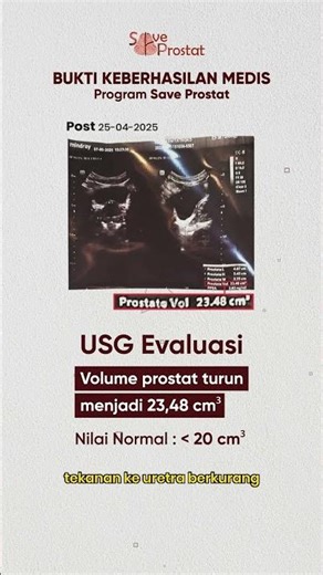 Ultrasound Proves: Prostate Volume Can Be Reduced