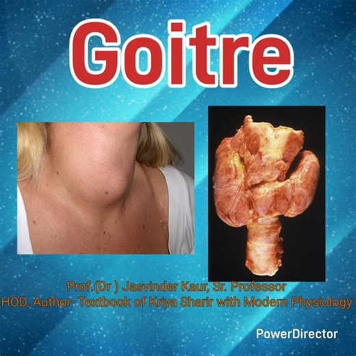 Goitre