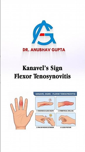 Kanavel’s Signs Explained | Flexor Tenosynovitis in 60 Seconds #handsurgery #medicaleducation