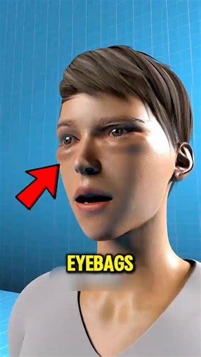 Eye Bags Explained — It’s Not Just About Sleep 😱