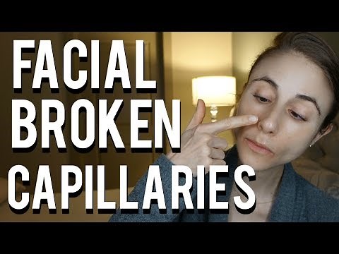 How to get rid of broken capillaries on the face| Dr Dray