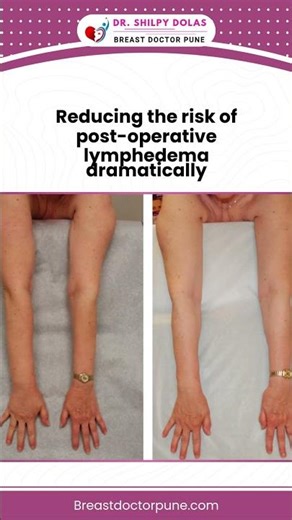 How Lymphedema Is Prevented After Breast Cancer Surgery | Dr. Shilpy Dolas - Breast Specialist Pune