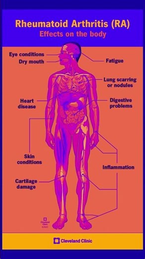Clinical presentation of Rheumatoid Arthritis
