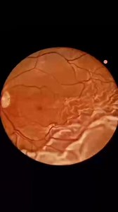 11K views · 70 reactions | Pars plana vitrectomy (PPV) is today a key...