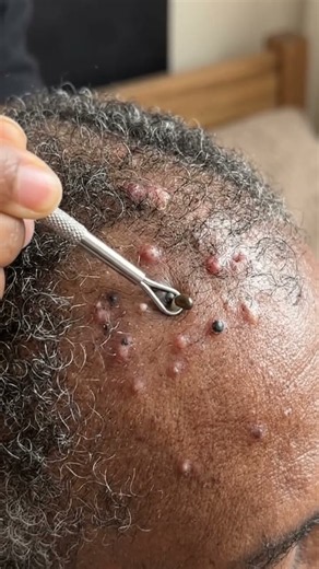 Professional Scalp Acne and Bump Extraction Treatment