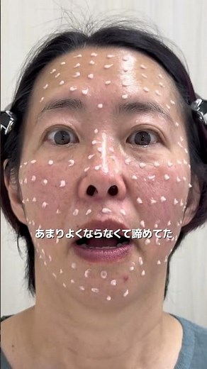 カビかと思ったら、実はこれ脂漏性皮膚炎でした‼️中々治らなかったですが、これ使ったらとても綺麗に✨オススメすぎます！#katan #針美容液 #カタンダーマヒットセラム #エイジングケア #美容 PR