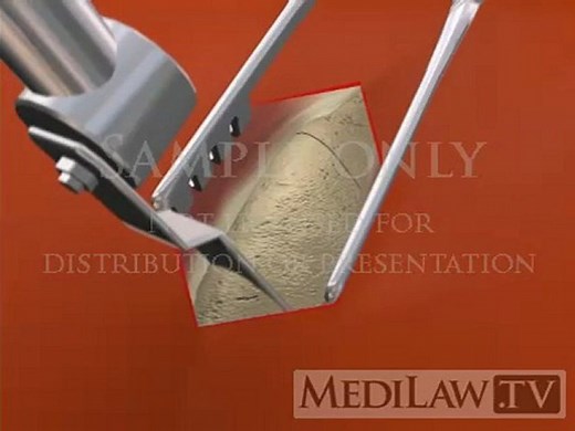 Bone Graft Harvesting Surgery anterior iliac crest neurosurgery animations