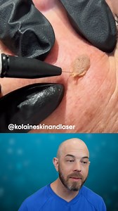 118K views · 650 reactions | Nice and quick Seborrheic Keratosis removal (credit: @kolaineskinandlaser on TT) #satisfying #skin | Dr. Dustin Portela, Dermatologist | Facebook