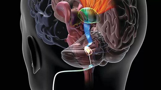Deep Brain Stimulation After Stroke: What Underlies Improved Motor Function?