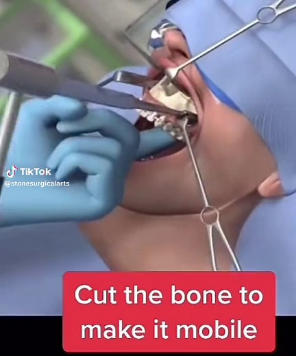 What happens during lefort osteotomy #lefort1 #jawsurgery #orthognathi... | surgery