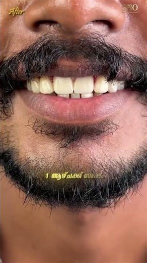 Smile transformation in one week🫶🏻Smile makeover achieve your dream smile #smiledesign #veneers
