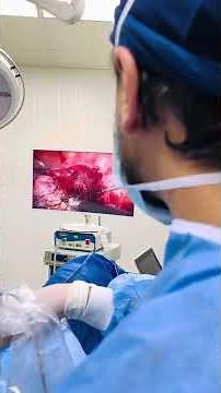 15 cm fibroid removal by key hole surgery ( laparoscopy ) #drbanna_egypt