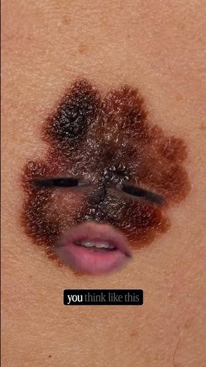 Melanoma can look harmless at first ☀️ Watch for changing moles before it’s too late 🩺