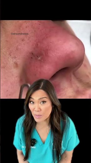 Extractions in a patient with acne - stop acne before it can start! #drpimplepopper #slmdskincare