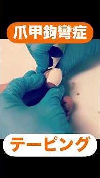 Taping for onychogryphosis (nail curvature). The nail is carefully filed down to a thin layer, an...