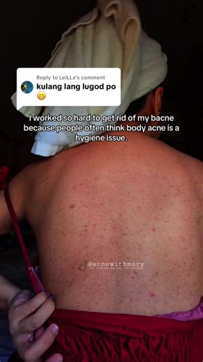 Transforming Bacne with Salicylic Acid: My Journey