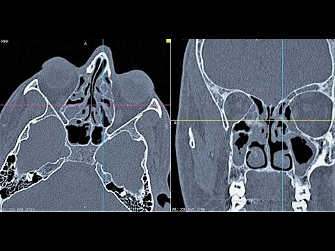 AXIAL CT PNS | HOW TO READ