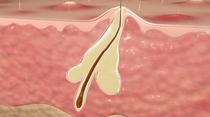 Hair Folicle Sebacious Gland Infected Pimple