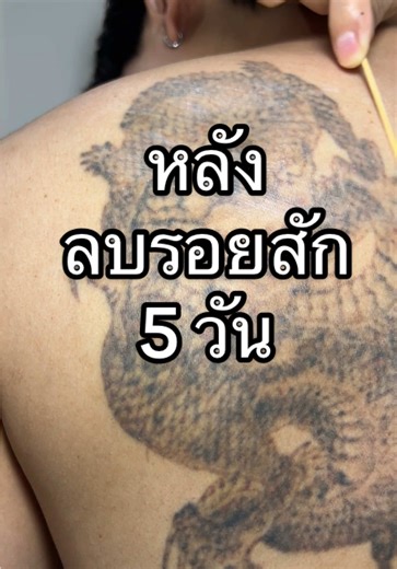 ลบรอยสัก 5 วันแล้ว เป็นยังไงบ้าง #ลบรอยสักด้วยเลเซอร์ #ลบรอยสัก #picolaser