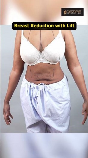 Breast Reduction With Breast Lift Marking