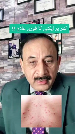 How to manage acne on back #acne#acnetreatment #acnefighter #acneskin#acneskincare