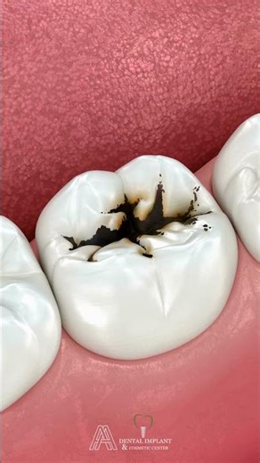 Composite Fillings in Cosmetic Dentistry: What Patients Gain 🎨