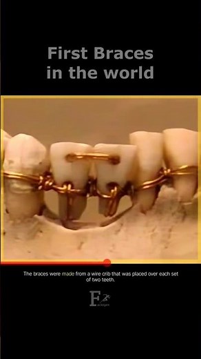 The first Braces in the world #braces #history #oldest #facts