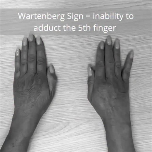 RK NURSE'S HUB on Instagram: "Wartenberg's sign is a clinical finding characterized by the involuntary, persistent abduction (drifting away) of the little finger. It primarily indicates an ulnar nerve palsy, often resulting from compression at the cubital tunnel in the elbow or Guyon's canal in the wrist. Mechanism The sign is caused by a muscle imbalance in the hand: Weakness: Paralysis of the ulnar-innervated palmar interosseous muscle, which normally adducts (pulls in) the little finger. Unop