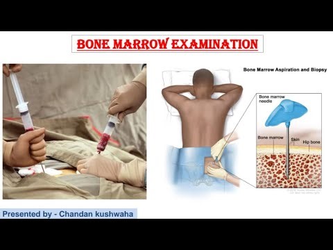 Bone Marrow Examination , bone marrow staining