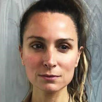 CryoSkin Facial Before and After