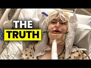 The truth about corrective jaw surgery for an underbite.