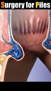 hemorrhoid surgery 3D animation #doctor #documentaryphotography #DoctorWho # reel # shorts #DoctorWh# | SMART Doctor