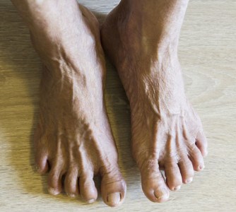 Ankle Fractures Can Be Death Sentences For Seniors - Lance Silverman, MD - Orthopedic Foot & Ankle Surgeon