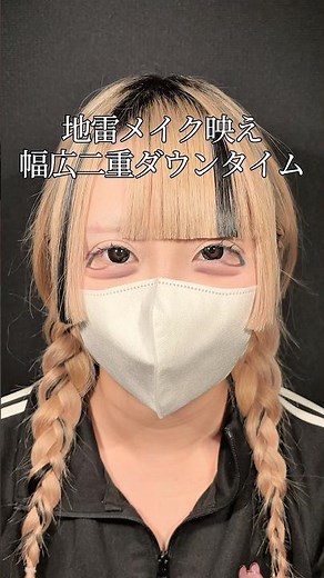 幅広二重の3ヶ月までの経過！#二重整形 #眼瞼下垂 #地雷系