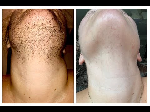 Before & After Electrolysis Results - 170 Hours of Permanent Facial Hair Removal - PCOS / Hirsutism