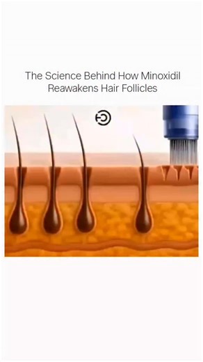 Science on Instagram: "Minoxidil works by increasing blood flow to the scalp and stimulating dormant hair follicles. It extends the hair growth phase, strengthens weakened follicles, and helps revive areas affected by hair thinning. This is how science helps bring hair back from the roots up. . . DM for credit and removal . #HairRegrowth #HumanBiology #ScalpHealth #ScienceReels #trending"