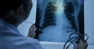 Silent symptom leads to lung cancer death of athletic non-smoker