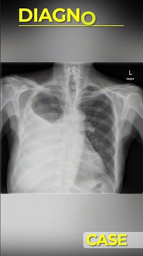 🚨 5 Chest X-Rays Every Intern Must Know #neetpg #fmge #medicalchallenge